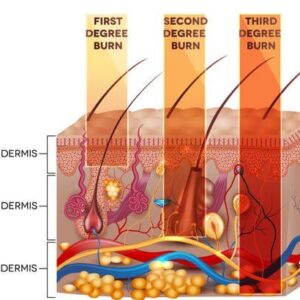 3 Types of Burn Injuries by Degree