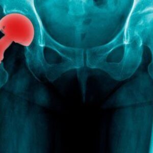 Hip Replacement Product Recalls Are On the Rise